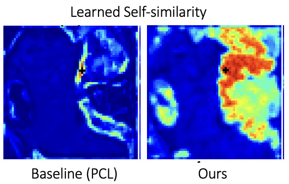 Keypoint-Augmented Self-Supervised Learning for Medical Image Segmentation with Limited Annotation