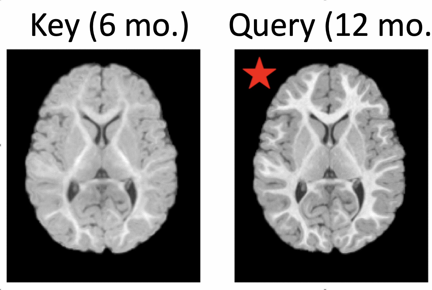 Local Spatiotemporal Representation Learning for Longitudinally-consistent Neuroimage Analysis